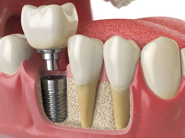 Diş implantı uygulaması