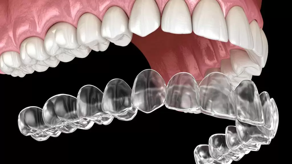 Şeffaf plak Invisalign tedavisi